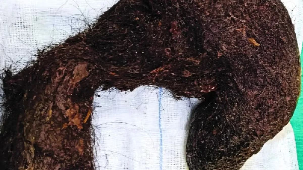 Midesinde adeta boş yer kalmamış! Doktorlar 1,16 kiloluk dev saç yumağını çıkardı